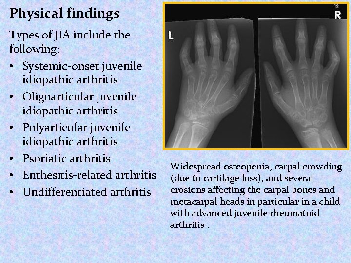 Physical findings Types of JIA include the following: • Systemic-onset juvenile idiopathic arthritis •