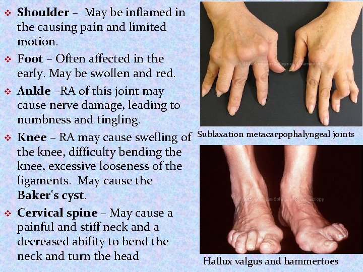 v v v Shoulder – May be inflamed in the causing pain and limited