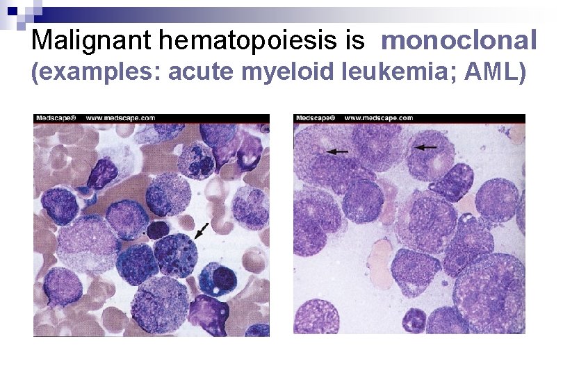 Malignant hematopoiesis is monoclonal (examples: acute myeloid leukemia; AML) Malignant hematopoiesis is monoclonal (examples: acute myeloid leukemia; AML)