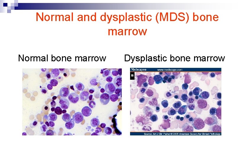 Normal and dysplastic (MDS) bone marrow Normal bone marrow Dysplastic bone marrow 