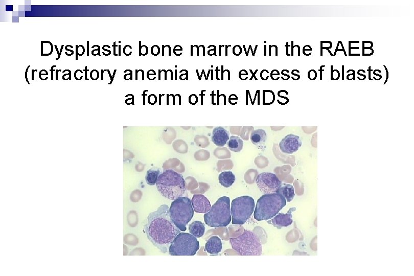 Dysplastic bone marrow in the RAEB (refractory anemia with excess of blasts) a form
