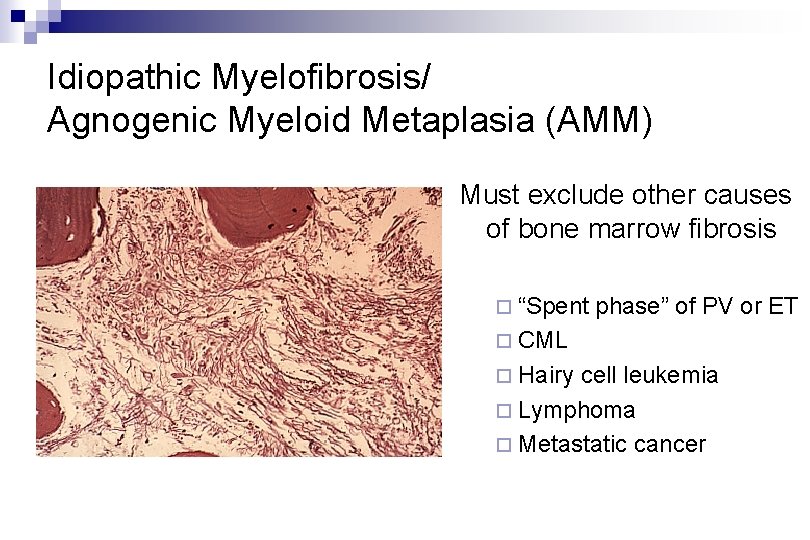 Idiopathic Myelofibrosis/ Agnogenic Myeloid Metaplasia (AMM) Must exclude other causes of bone marrow fibrosis Idiopathic Myelofibrosis/ Agnogenic Myeloid Metaplasia (AMM) Must exclude other causes of bone marrow fibrosis