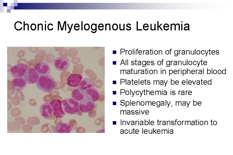 Chonic Myelogenous Leukemia n n n Proliferation of granulocytes All stages of granulocyte maturation
