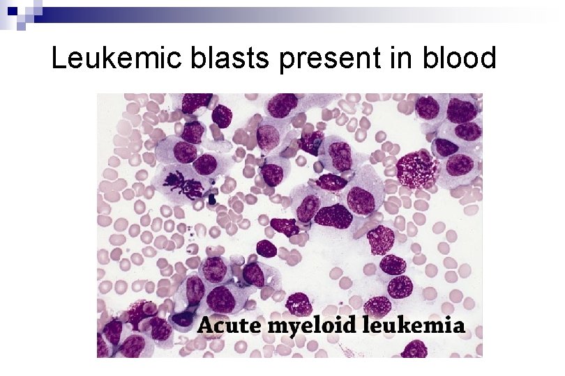 Leukemic blasts present in blood Leukemic blasts present in blood
