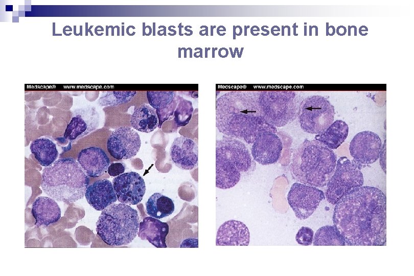 Leukemic blasts are present in bone marrow 