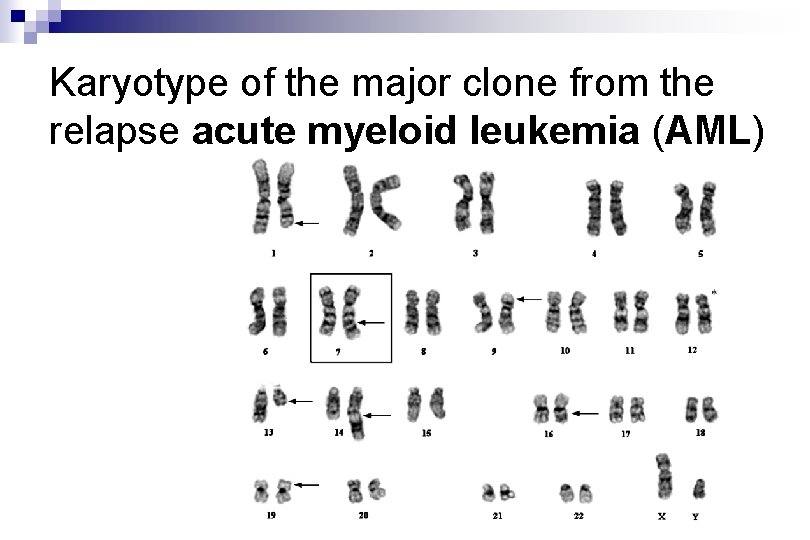 Karyotype of the major clone from the relapse acute myeloid leukemia (AML) Karyotype of the major clone from the relapse acute myeloid leukemia (AML)