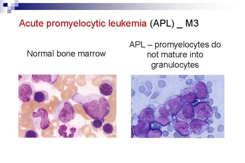 Acute promyelocytic leukemia (APL) _ M 3 Normal bone marrow APL – promyelocytes do