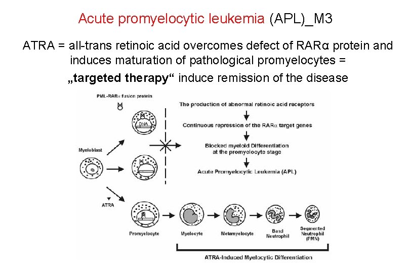 Acute promyelocytic leukemia (APL)_M 3 ATRA = all-trans retinoic acid overcomes defect of RARα Acute promyelocytic leukemia (APL)_M 3 ATRA = all-trans retinoic acid overcomes defect of RARα