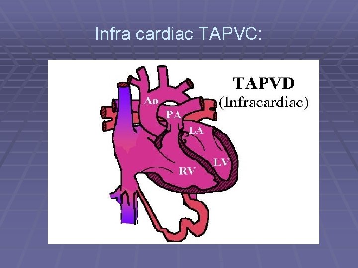 Infra cardiac TAPVC: 