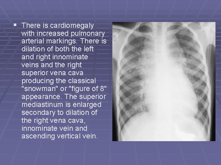 § There is cardiomegaly with increased pulmonary arterial markings. There is dilation of both