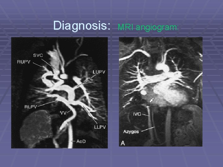 Diagnosis: MRI angiogram: 