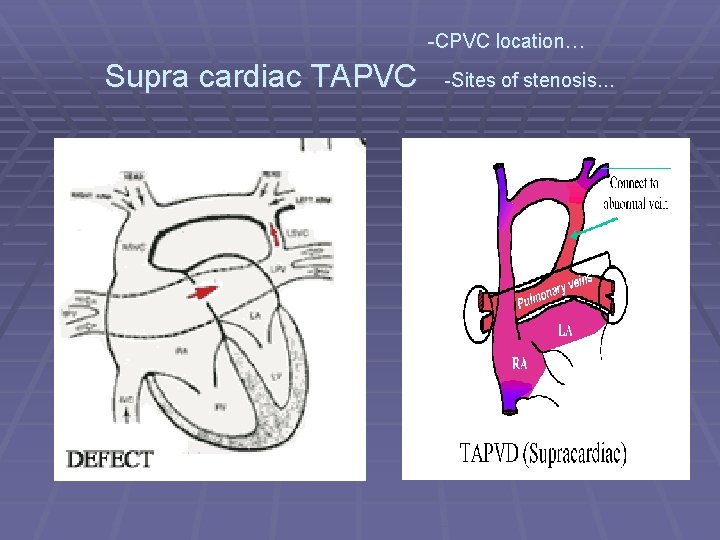 -CPVC location… Supra cardiac TAPVC -Sites of stenosis… 