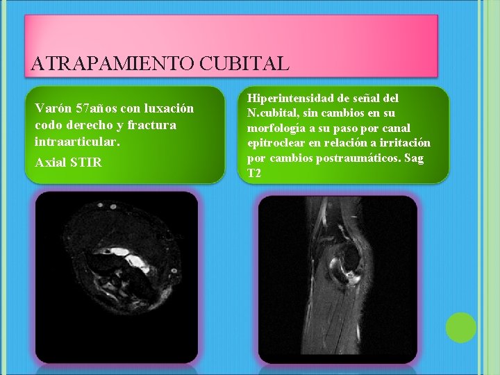 ATRAPAMIENTO CUBITAL Varón 57 años con luxación codo derecho y fractura intraarticular. Axial STIR