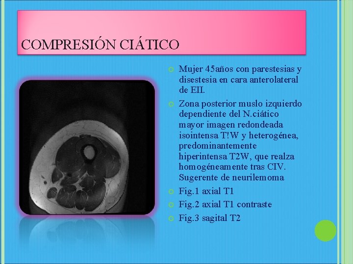 COMPRESIÓN CIÁTICO Mujer 45 años con parestesias y disestesia en cara anterolateral de EII.