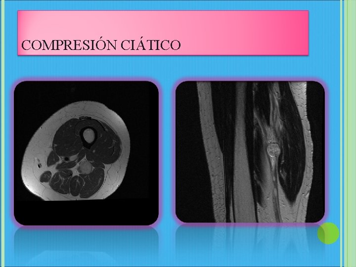 COMPRESIÓN CIÁTICO 