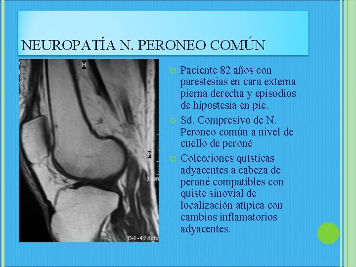 NEUROPATÍA N. PERONEO COMÚN Paciente 82 años con parestesias en cara externa pierna derecha