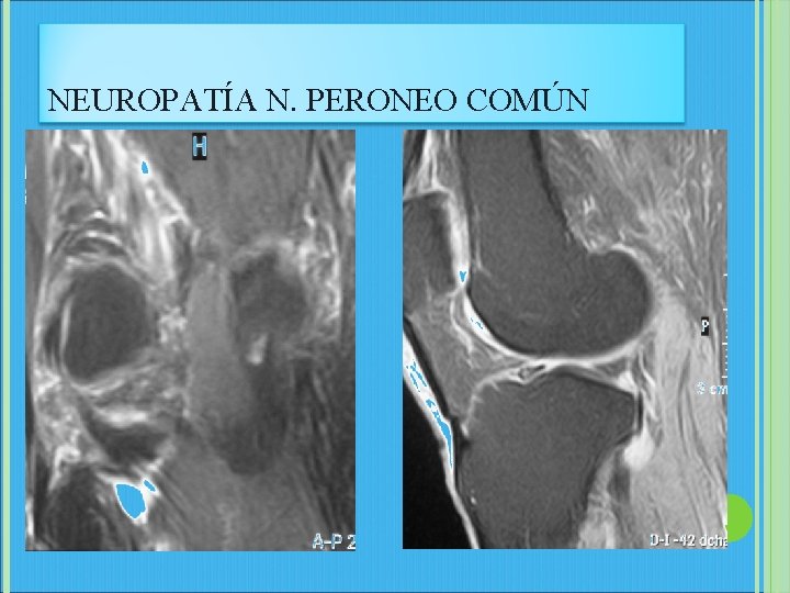 NEUROPATÍA N. PERONEO COMÚN 