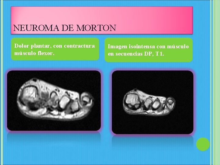 NEUROMA DE MORTON Dolor plantar, contractura músculo flexor. Imagen isointensa con músculo en secuencias