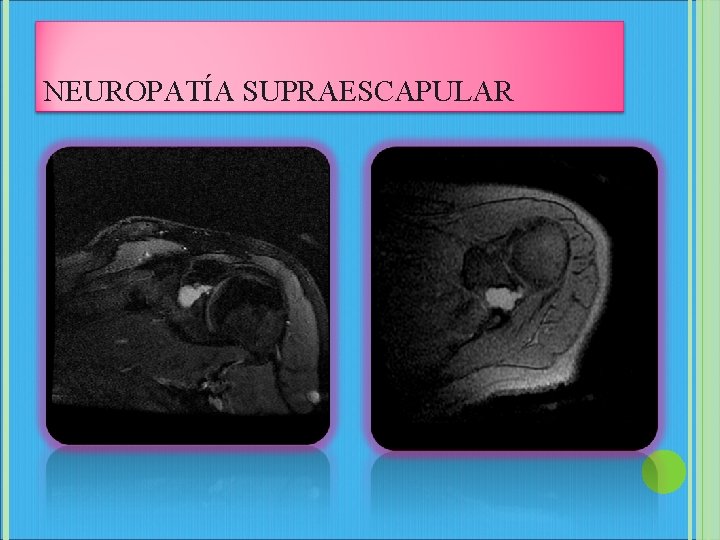 NEUROPATÍA SUPRAESCAPULAR 