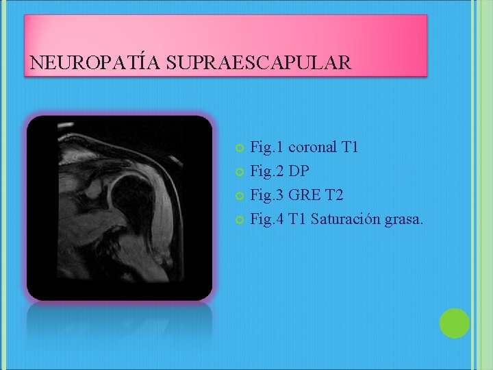 NEUROPATÍA SUPRAESCAPULAR Fig. 1 coronal T 1 Fig. 2 DP Fig. 3 GRE T