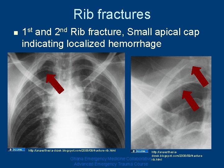 Rib fractures n 1 st and 2 nd Rib fracture, Small apical cap indicating Rib fractures n 1 st and 2 nd Rib fracture, Small apical cap indicating
