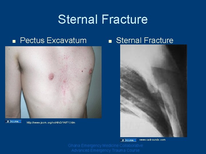 Sternal Fracture n Pectus Excavatum n Sternal Fracture http: //www. jssm. org/vol 4/n 3/14/F Sternal Fracture n Pectus Excavatum n Sternal Fracture http: //www. jssm. org/vol 4/n 3/14/F