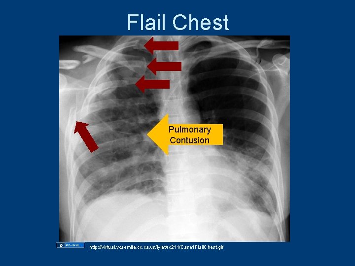 Flail Chest Pulmonary Contusion http: //virtual. yosemite. cc. ca. us/lylet/rc 211/Case 1 Flail. Chest. Flail Chest Pulmonary Contusion http: //virtual. yosemite. cc. ca. us/lylet/rc 211/Case 1 Flail. Chest.