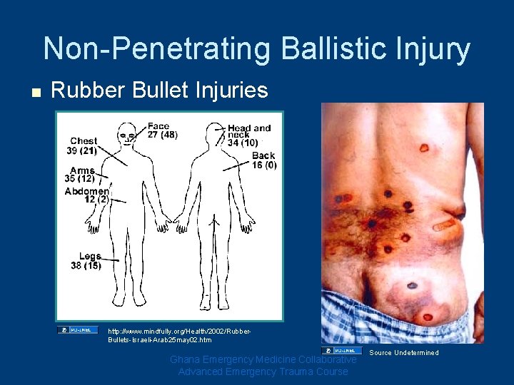 Non-Penetrating Ballistic Injury n Rubber Bullet Injuries http: //www. mindfully. org/Health/2002/Rubber. Bullets-Israeli-Arab 25 may Non-Penetrating Ballistic Injury n Rubber Bullet Injuries http: //www. mindfully. org/Health/2002/Rubber. Bullets-Israeli-Arab 25 may