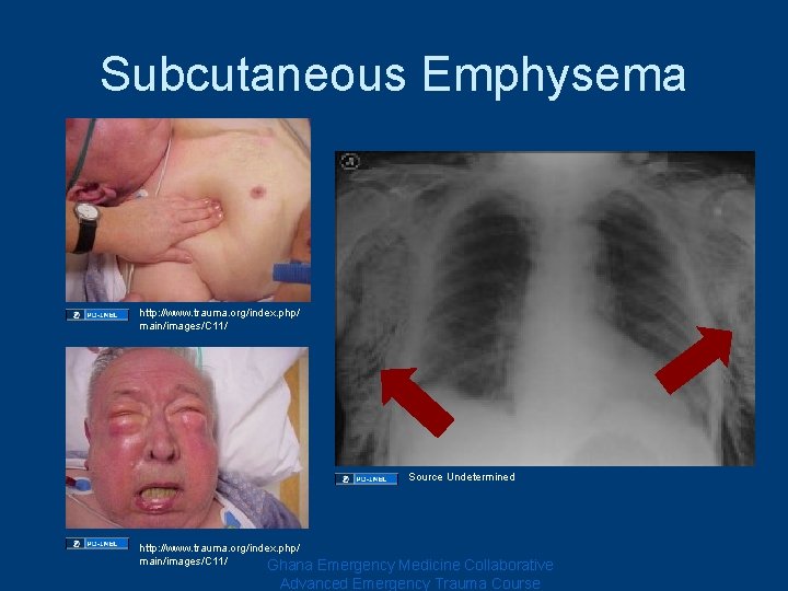 Subcutaneous Emphysema http: //www. trauma. org/index. php/ main/images/C 11/ Source Undetermined http: //www. trauma. Subcutaneous Emphysema http: //www. trauma. org/index. php/ main/images/C 11/ Source Undetermined http: //www. trauma.