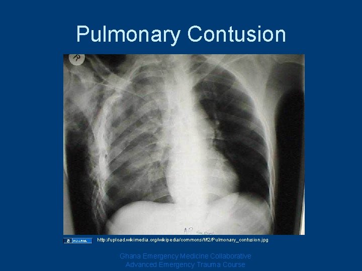 Pulmonary Contusion http: //upload. wikimedia. org/wikipedia/commons/f/f 2/Pulmonary_contusion. jpg Ghana Emergency Medicine Collaborative Advanced Emergency Pulmonary Contusion http: //upload. wikimedia. org/wikipedia/commons/f/f 2/Pulmonary_contusion. jpg Ghana Emergency Medicine Collaborative Advanced Emergency