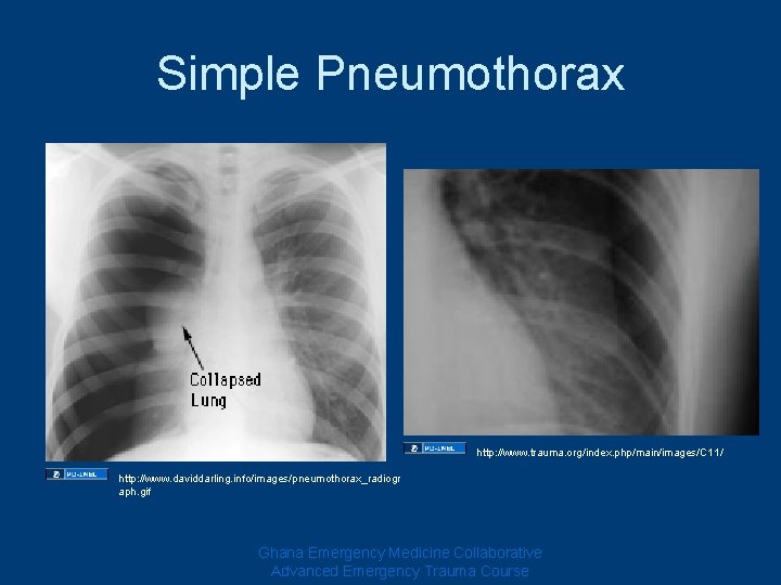 Simple Pneumothorax http: //www. trauma. org/index. php/main/images/C 11/ http: //www. daviddarling. info/images/pneumothorax_radiogr aph. gif Simple Pneumothorax http: //www. trauma. org/index. php/main/images/C 11/ http: //www. daviddarling. info/images/pneumothorax_radiogr aph. gif