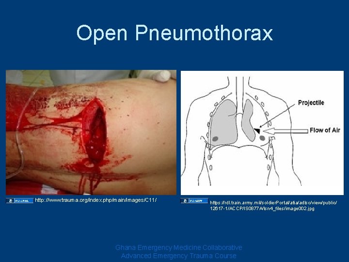 Open Pneumothorax http: //www. trauma. org/index. php/main/images/C 11/ https: //rdl. train. army. mil/soldier. Portal/atia/adlsc/view/public/ Open Pneumothorax http: //www. trauma. org/index. php/main/images/C 11/ https: //rdl. train. army. mil/soldier. Portal/atia/adlsc/view/public/