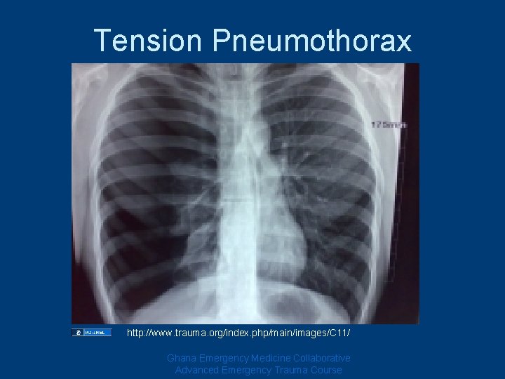 Tension Pneumothorax http: //www. trauma. org/index. php/main/images/C 11/ Ghana Emergency Medicine Collaborative Advanced Emergency Tension Pneumothorax http: //www. trauma. org/index. php/main/images/C 11/ Ghana Emergency Medicine Collaborative Advanced Emergency