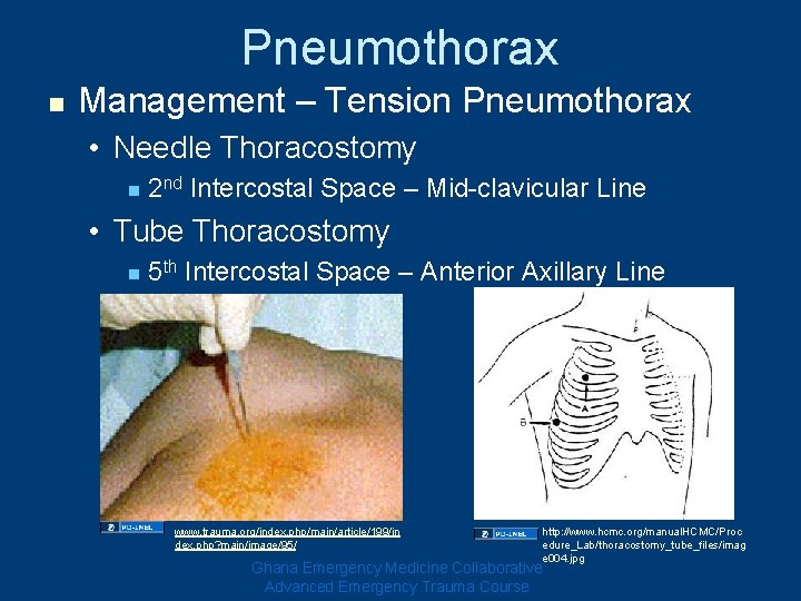 Pneumothorax n Management – Tension Pneumothorax • Needle Thoracostomy n 2 nd Intercostal Space Pneumothorax n Management – Tension Pneumothorax • Needle Thoracostomy n 2 nd Intercostal Space