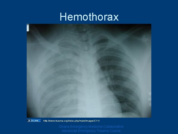 Hemothorax http: //www. trauma. org/index. php/main/images/C 11/ Ghana Emergency Medicine Collaborative Advanced Emergency Trauma Hemothorax http: //www. trauma. org/index. php/main/images/C 11/ Ghana Emergency Medicine Collaborative Advanced Emergency Trauma