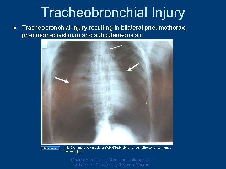 Tracheobronchial Injury n Tracheobronchial injury resulting in bilateral pneumothorax, pneumomediastinum and subcutaneous air http: Tracheobronchial Injury n Tracheobronchial injury resulting in bilateral pneumothorax, pneumomediastinum and subcutaneous air http: