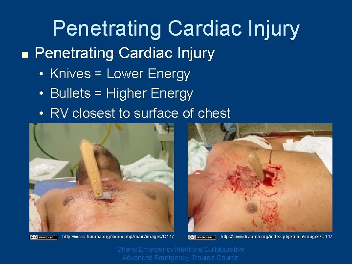 Penetrating Cardiac Injury n Penetrating Cardiac Injury • Knives = Lower Energy • Bullets Penetrating Cardiac Injury n Penetrating Cardiac Injury • Knives = Lower Energy • Bullets