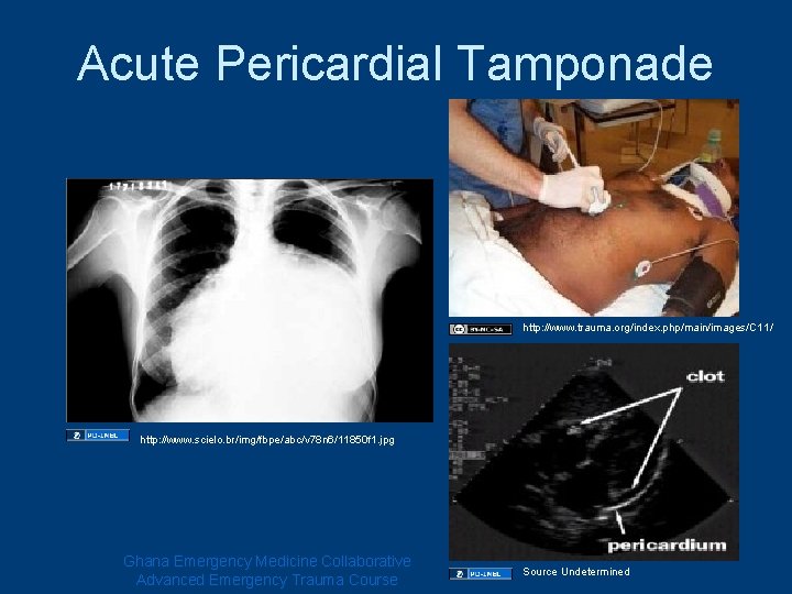 Acute Pericardial Tamponade http: //www. trauma. org/index. php/main/images/C 11/ http: //www. scielo. br/img/fbpe/abc/v 78 Acute Pericardial Tamponade http: //www. trauma. org/index. php/main/images/C 11/ http: //www. scielo. br/img/fbpe/abc/v 78