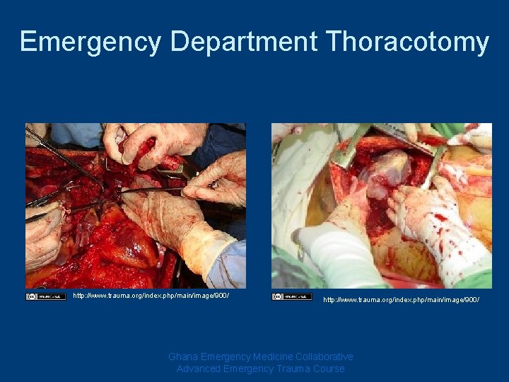 Emergency Department Thoracotomy http: //www. trauma. org/index. php/main/image/900/ Ghana Emergency Medicine Collaborative Advanced Emergency Emergency Department Thoracotomy http: //www. trauma. org/index. php/main/image/900/ Ghana Emergency Medicine Collaborative Advanced Emergency