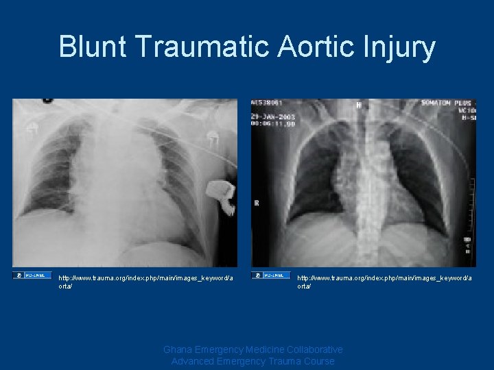 Blunt Traumatic Aortic Injury http: //www. trauma. org/index. php/main/images_keyword/a orta/ Ghana Emergency Medicine Collaborative Blunt Traumatic Aortic Injury http: //www. trauma. org/index. php/main/images_keyword/a orta/ Ghana Emergency Medicine Collaborative
