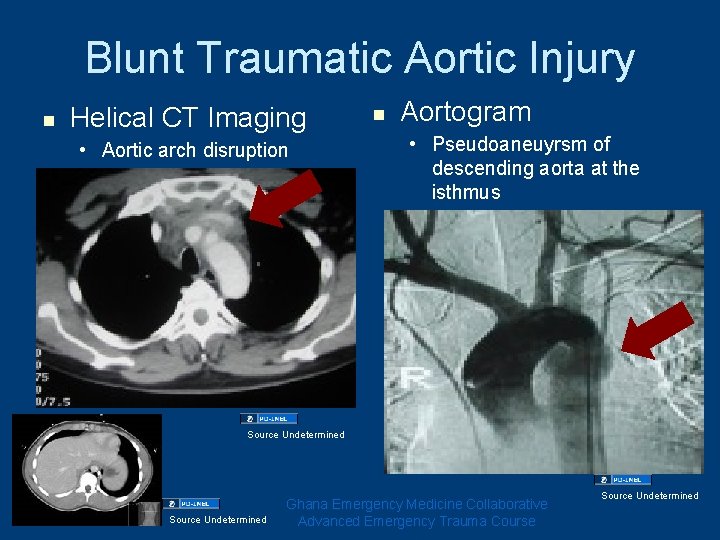 Blunt Traumatic Aortic Injury n Helical CT Imaging • Aortic arch disruption n Aortogram Blunt Traumatic Aortic Injury n Helical CT Imaging • Aortic arch disruption n Aortogram