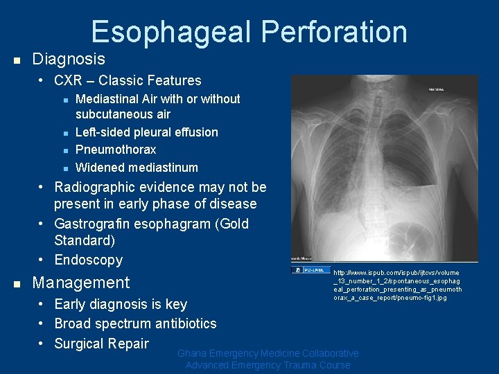 Esophageal Perforation n Diagnosis • CXR – Classic Features n n Mediastinal Air with Esophageal Perforation n Diagnosis • CXR – Classic Features n n Mediastinal Air with