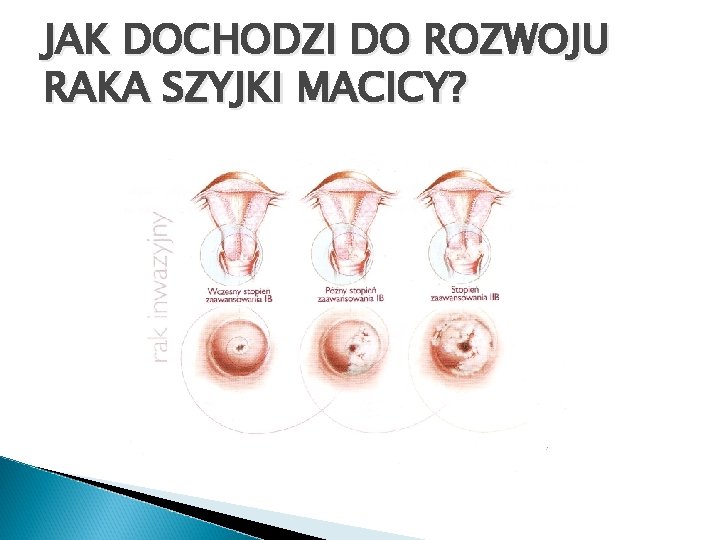 JAK DOCHODZI DO ROZWOJU RAKA SZYJKI MACICY? 