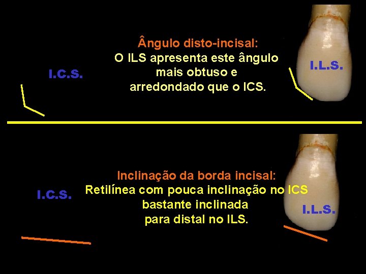 I. C. S. ngulo disto-incisal: O ILS apresenta este ângulo mais obtuso e arredondado I. C. S. ngulo disto-incisal: O ILS apresenta este ângulo mais obtuso e arredondado