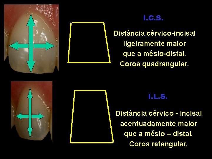 I. C. S. Distância cérvico-incisal ligeiramente maior que a mésio-distal. Coroa quadrangular. I. L. I. C. S. Distância cérvico-incisal ligeiramente maior que a mésio-distal. Coroa quadrangular. I. L.