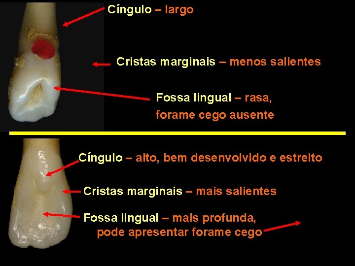 Cíngulo – largo Cristas marginais – menos salientes Fossa lingual – rasa, forame cego Cíngulo – largo Cristas marginais – menos salientes Fossa lingual – rasa, forame cego