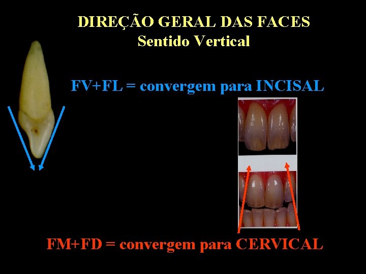 DIREÇÃO GERAL DAS FACES Sentido Vertical FV+FL = convergem para INCISAL FM+FD = convergem DIREÇÃO GERAL DAS FACES Sentido Vertical FV+FL = convergem para INCISAL FM+FD = convergem