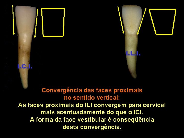 I. L. I. I. C. I. Convergência das faces proximais no sentido vertical: As I. L. I. I. C. I. Convergência das faces proximais no sentido vertical: As