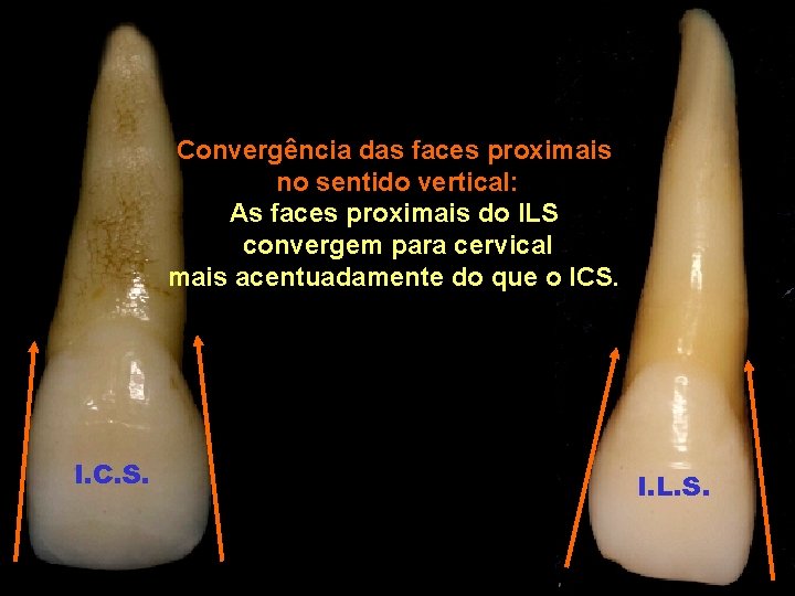 Convergência das faces proximais no sentido vertical: As faces proximais do ILS convergem para Convergência das faces proximais no sentido vertical: As faces proximais do ILS convergem para