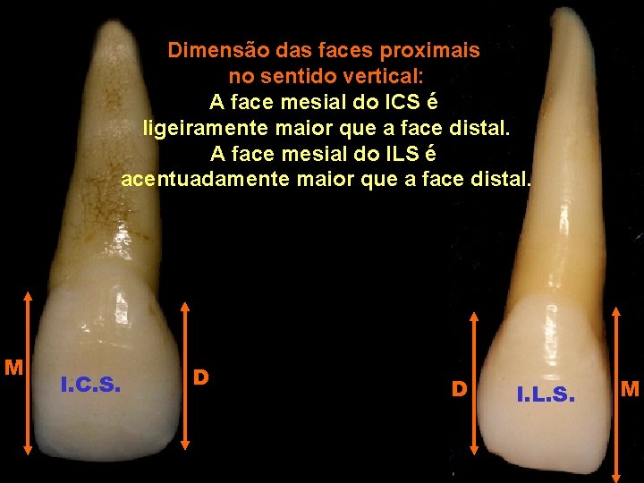 Dimensão das faces proximais no sentido vertical: A face mesial do ICS é ligeiramente Dimensão das faces proximais no sentido vertical: A face mesial do ICS é ligeiramente